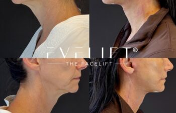 female patient before and after EVELIFT®