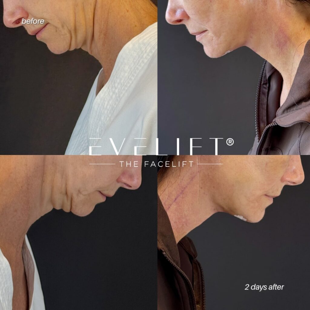 female patient before and after EVELIFT®
