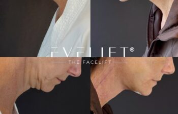 female patient before and after EVELIFT®