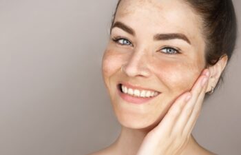 Caucasian woman's face with freckles or age spots, melasma